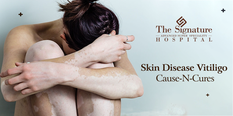 Skin Disease Vitiligo: Cause-N-Cures